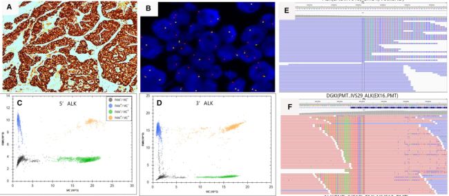 dPCR用于肺癌ALK基因檢測(cè)研究，J. Cancer Res. Clin. Onc., 2020